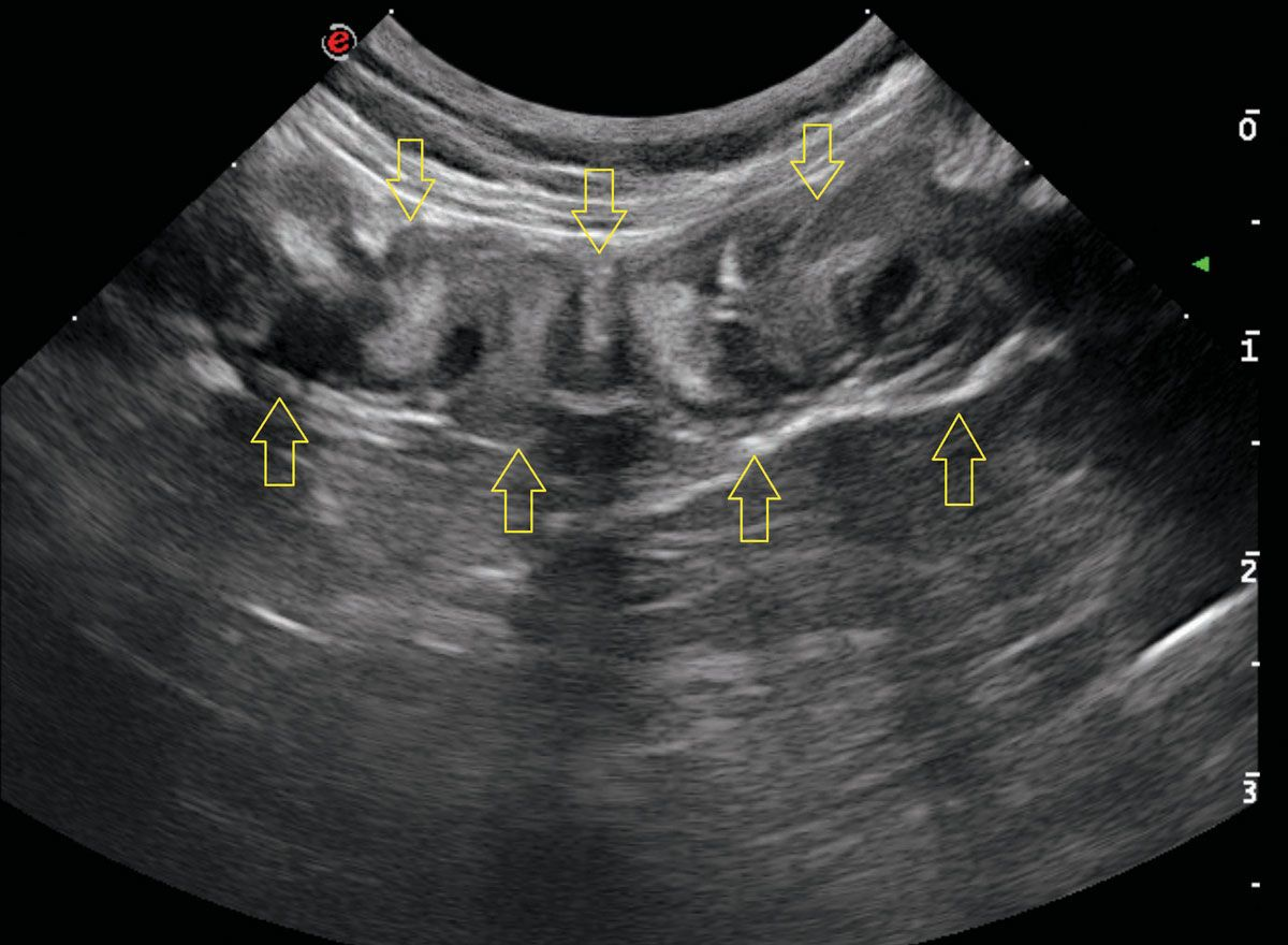 Image échographique d’une anse intestinale chez un chat adulte avec une plicature marquée de l’intestin grêle 