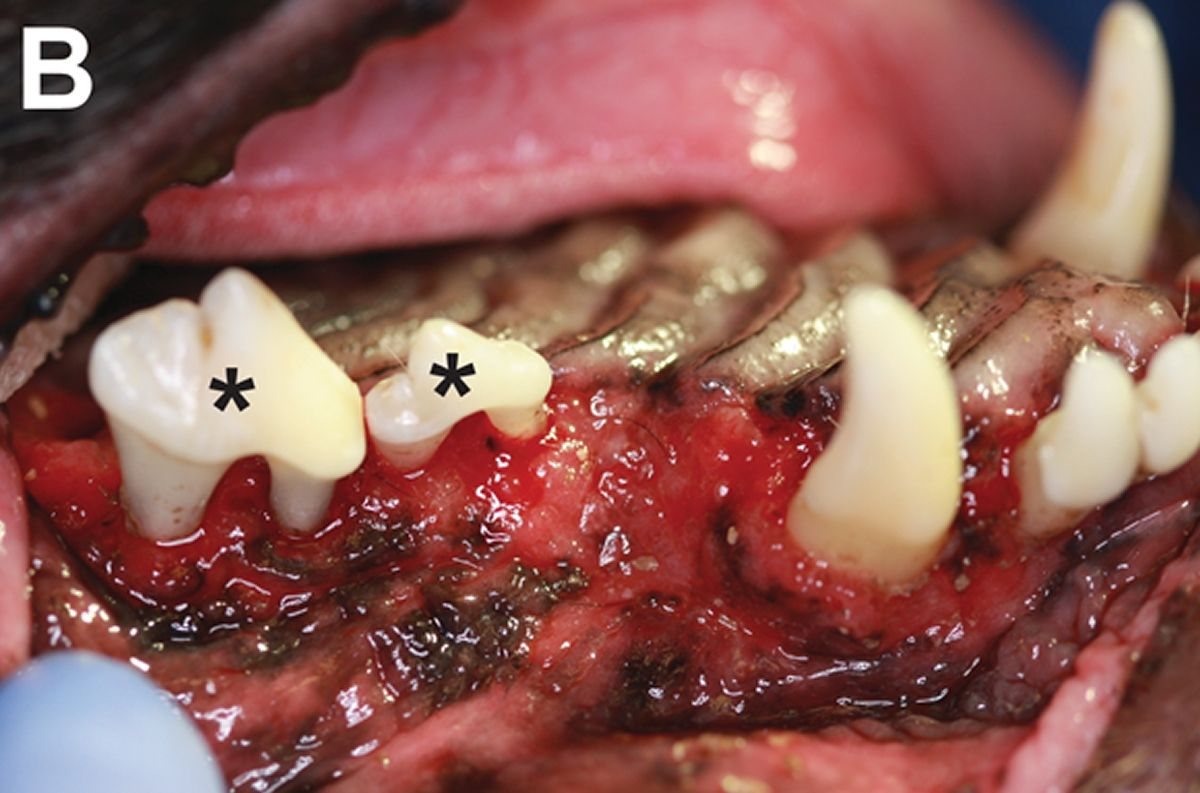 In the process of sonically and ultrasonically scaling the teeth, the left maxillary first and second premolar teeth and the first and second molar teeth were exfoliated. Note the marked gingivitis, alveolar bone loss, and furcation exposure of the third and fourth premolar teeth (asterisks). 