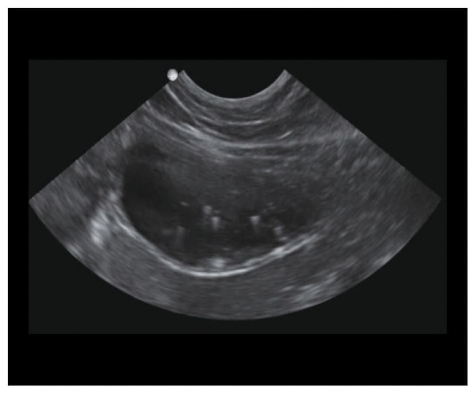 bladder stone ultrasound