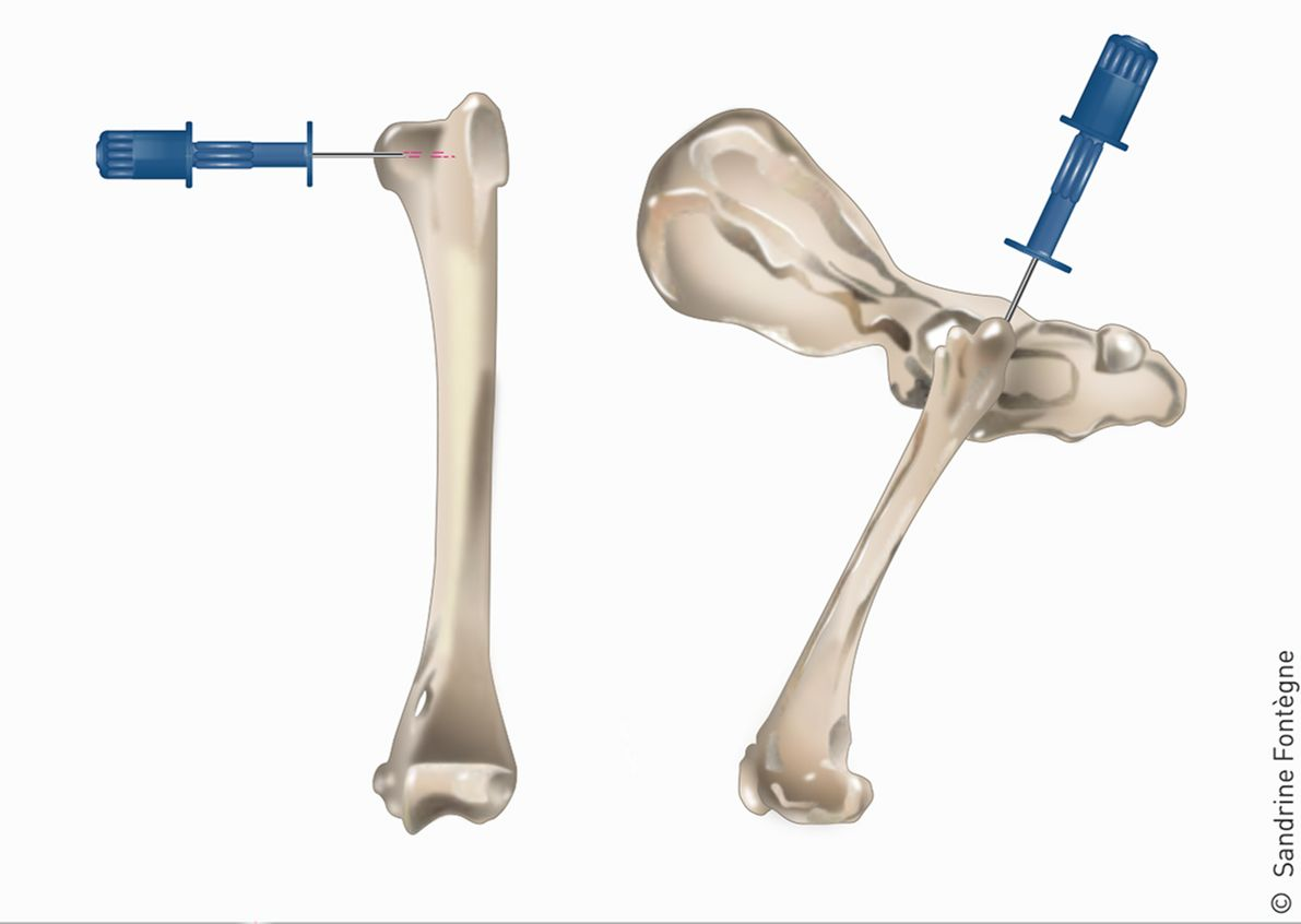 Um cateter intraósseo pode ser colocado na porção proximal do úmero ou do fêmur em pacientes com dificuldade de acesso venoso, conforme ilustrado na figura.