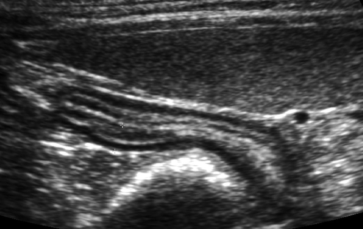 Scansione ecografica addominale che mostra una sezione sagittale dell’intestino tenue felino, evidenziando una parete intestinale ispessita.