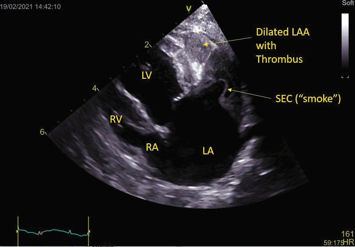 Herzultraschallbefunde können auf ein hohes Risiko für eine arterielle Thromboembolie hinweisen