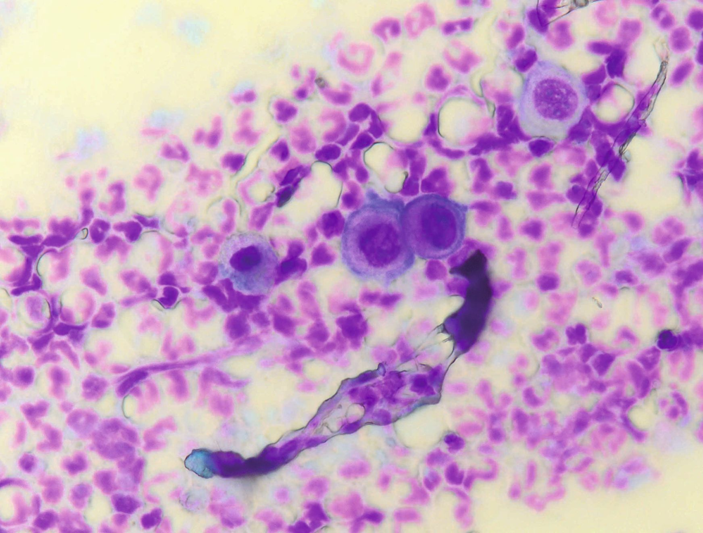 Cytology in feline pemphigus foliaceus; note the rounded (acantholytic) keratinocytes in small clusters (like “fried eggs”) surrounded by neutrophils.