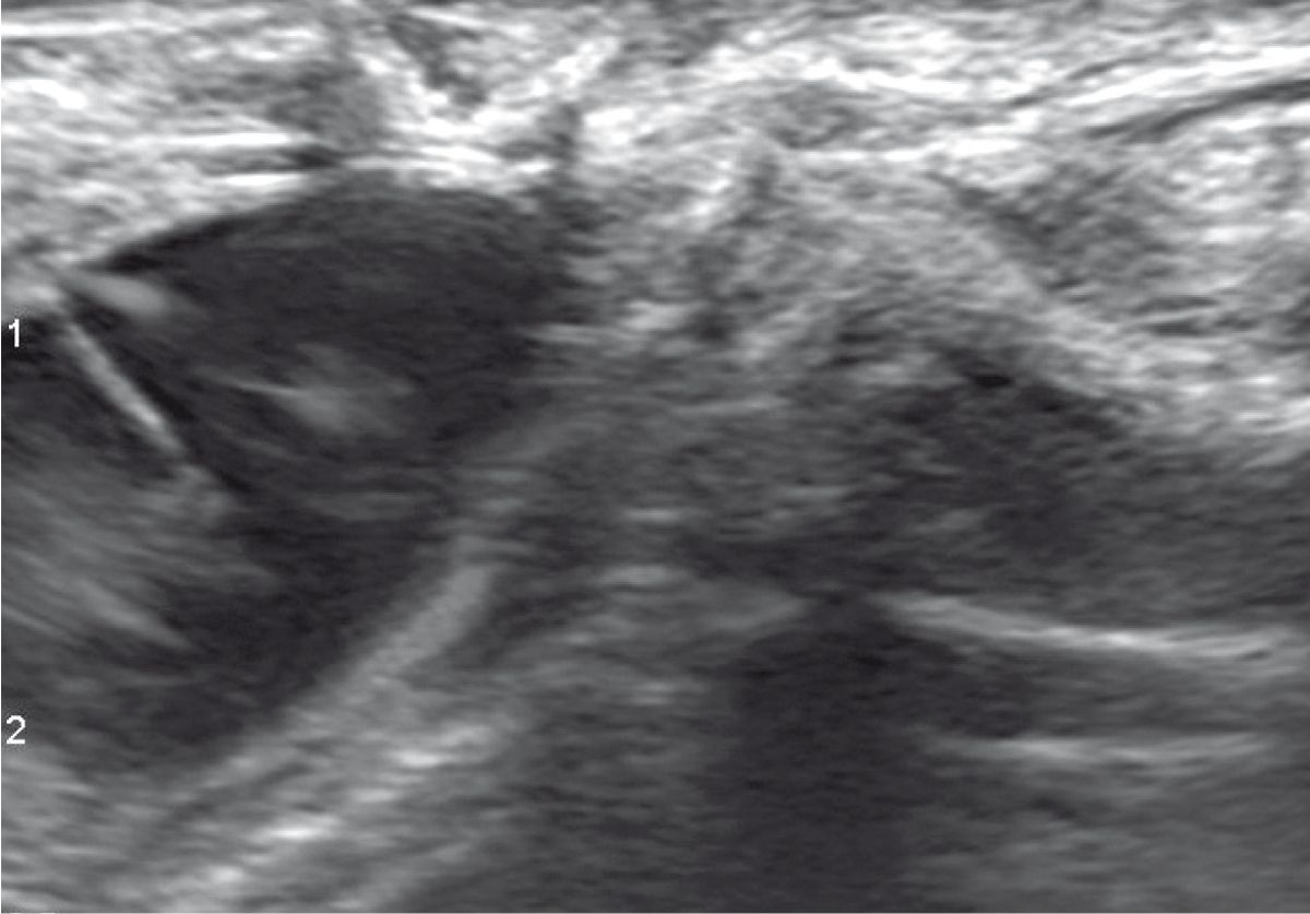  A feline gallbladder scan showing the aspiration needle as a linear hyerechoic structure in the process of aspirating bile with sludge (swirling hyperechoic material).