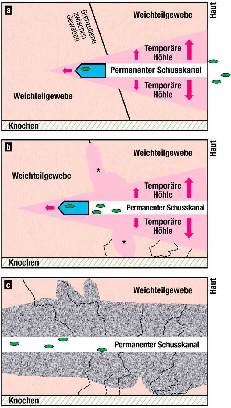  Ein Projektil dringt in den Krper ein und reit Bakterien und Debris von der Hautoberflche mit in die Tiefe des Gewebes
