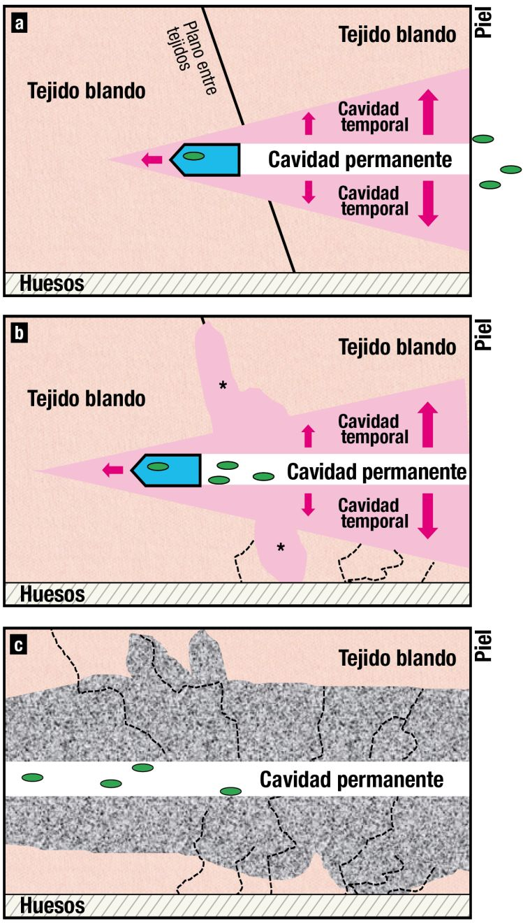 Figura 1.(a) El proyectil se introduce en el cuerpo arrastrando bacterias y detritos de la superficie cutánea.