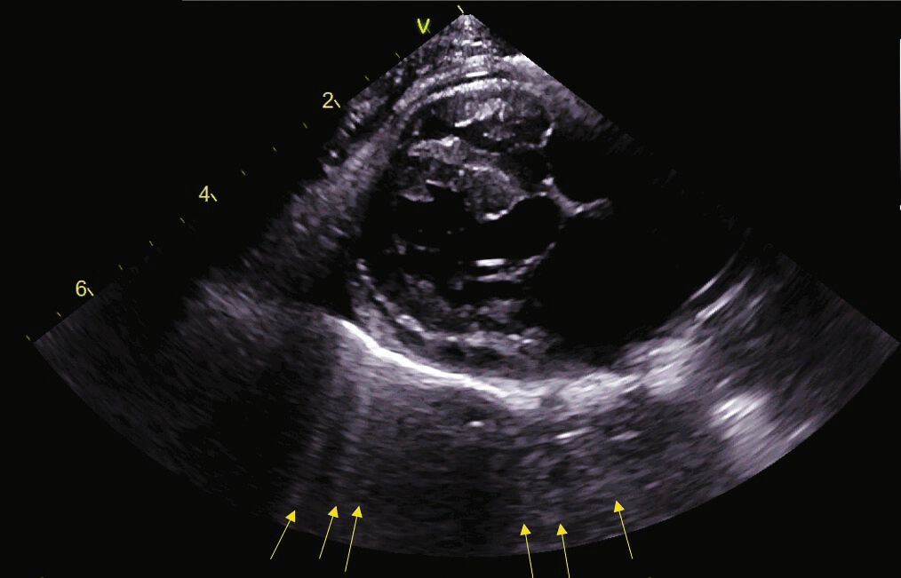Mise en évidence par POCUS (« point of care ultrasound ») thoracique d’une ICC chez le chat. Vue PSD (grand axe, 4 cavités) montrant des lignes B au-delà de l’interface péricarde-poumon 