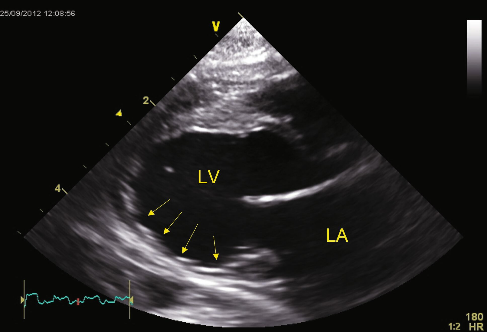 Vue PSD (grand axe, 4 cavités) montrant une cardiomyopathie en phase terminale d’un chat avec un infarctus du myocarde présumé et une fibrose de substitution 