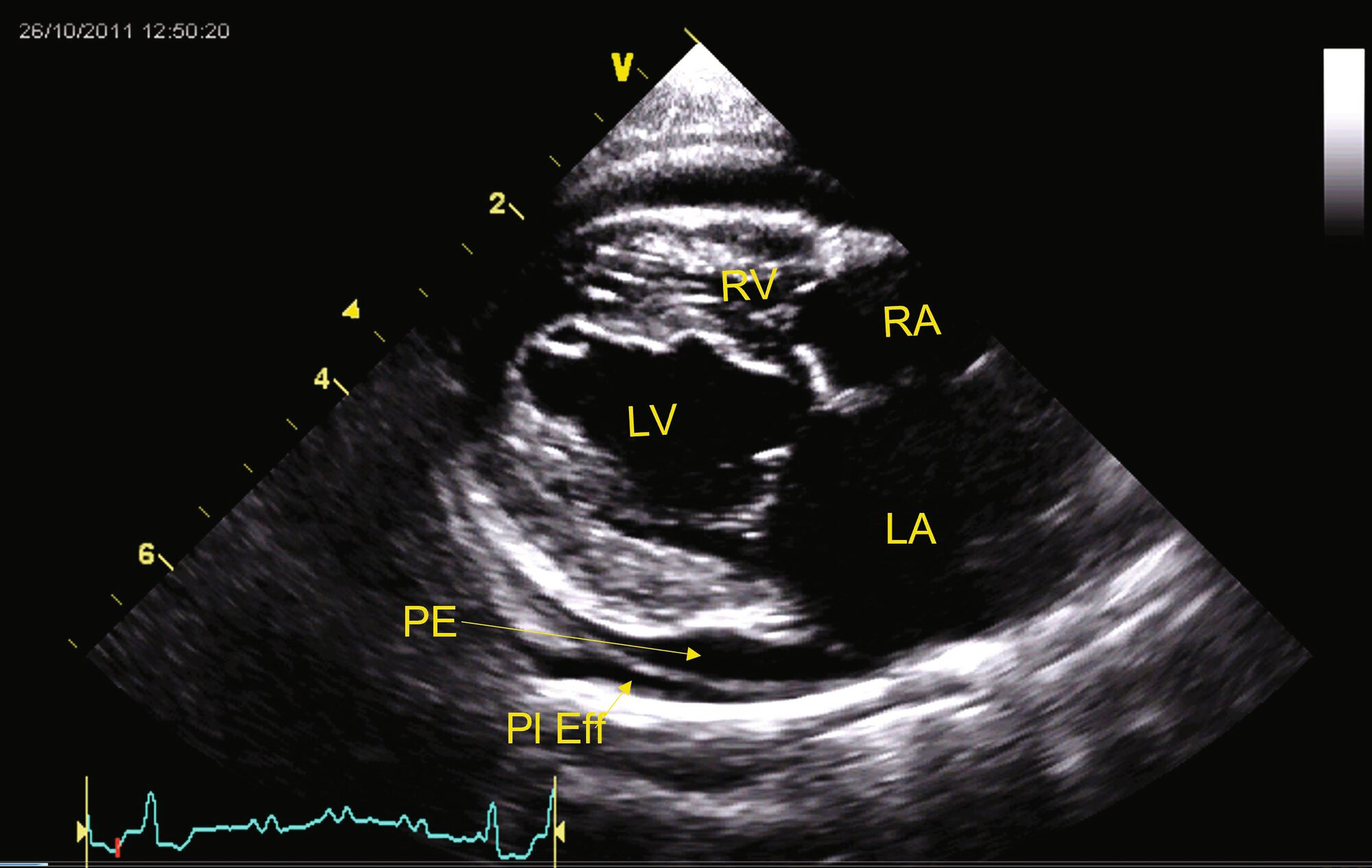 Vue PSD (grand axe, 4 chambres) d’un chat à poil court diagnostiqué avec une cardiomyopathie atypique