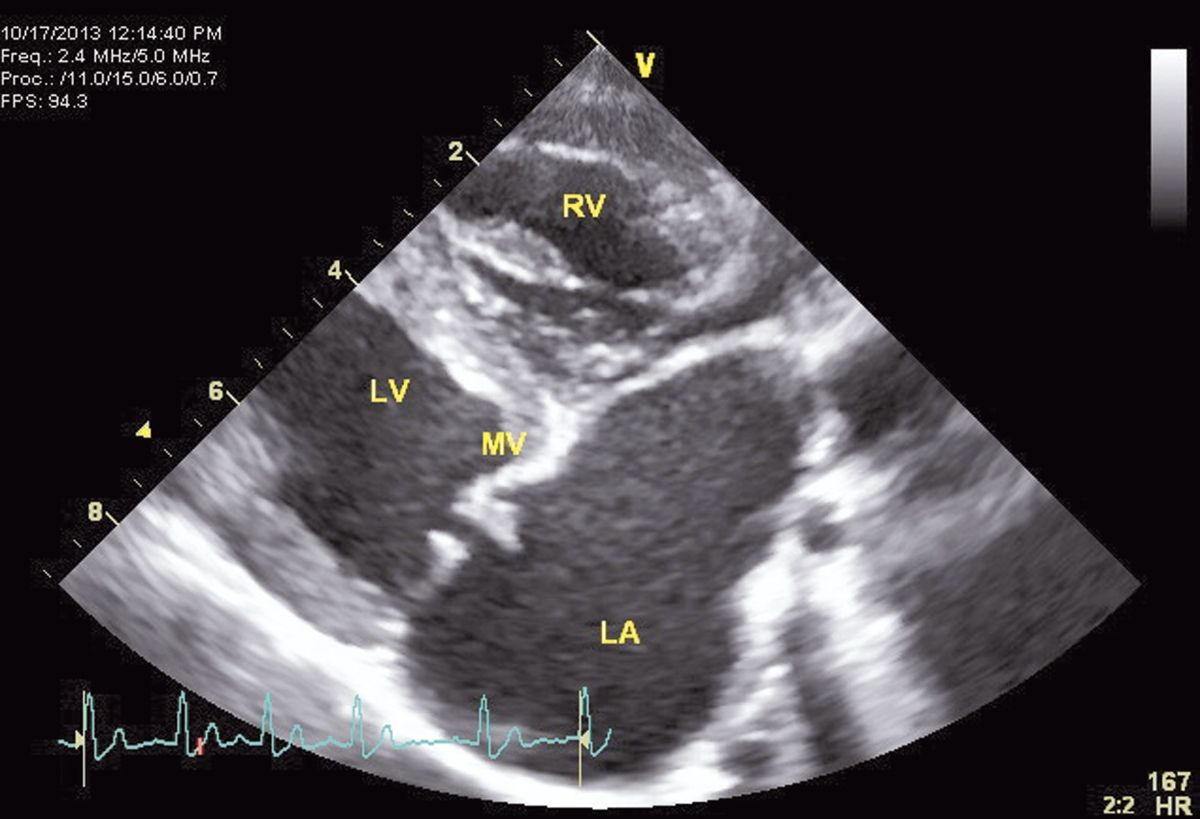 Image échocardiographique d’une maladie valvulaire dégénérative mitrale. La maladie valvulaire dégénérative est beaucoup plus fréquente chez les petites races canines. 