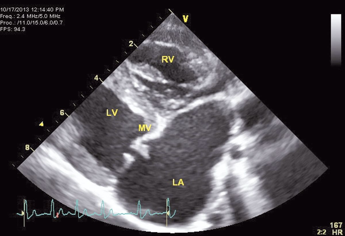 An echocardiographic image of mitral valve disease. Degenerative valve disease is much more common in small and toy breeds of dog.