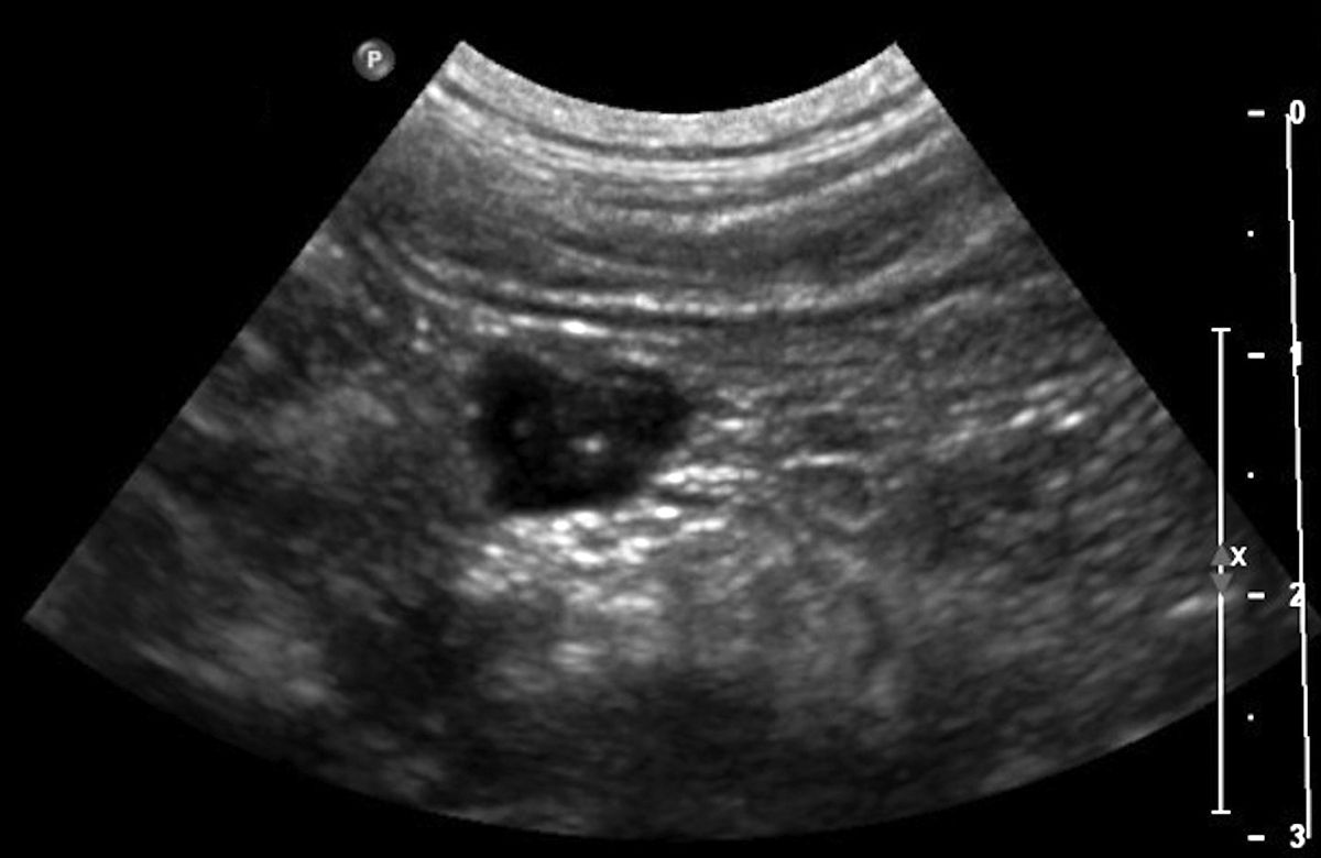 Immagine ecografica di un carcinoma pancreatico in un gatto, visualizzato come un nodulo ipoecogeno ben definito.