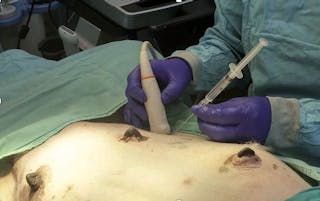 Performing centesis using the “freehand” technique