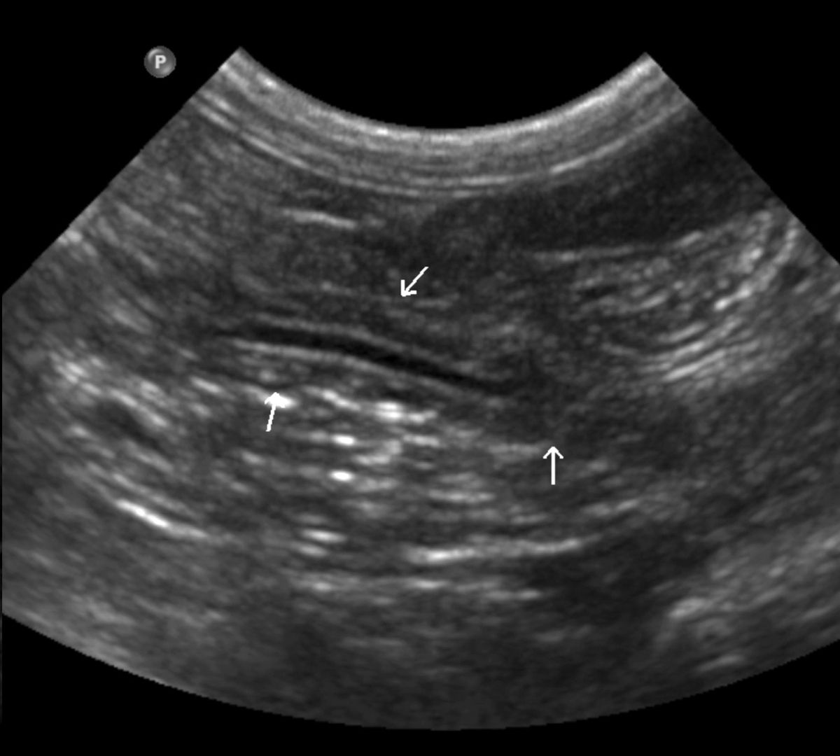 Ecografia di un pancreas normale (frecce bianche) in un gatto; il dotto pancreatico può aiutare a identificarlo.