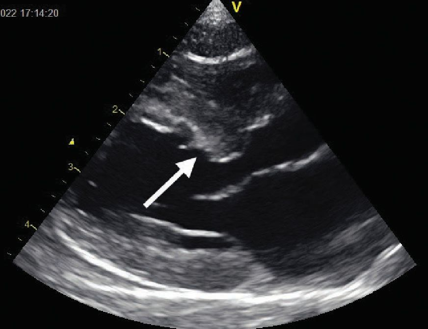 échocardiographie montre une hypertrophie septale localisée à la base du septum interventriculaire chez un chat atteint d’hyperthyroïdie et d’hypertension artérielle systémique