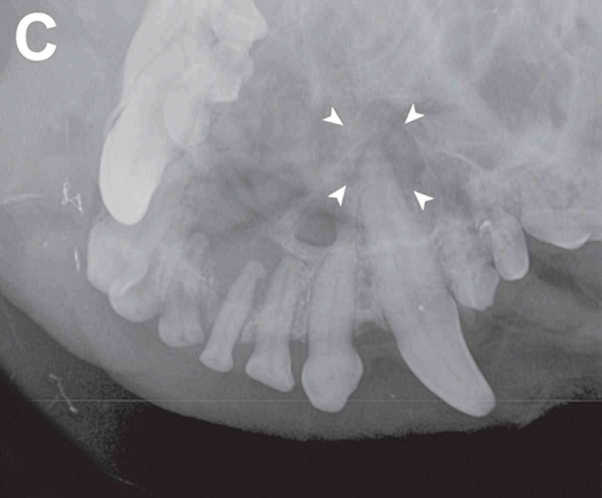 Une seconde radiographie (vue de la canine latérale gauche, technique de la bissectrice) a montré une canine maxillaire gauche dévitalisée [cavité pulpaire non rétrécie et transparence périapicale bien nette (flèches)]. Toutes les incisives maxillaires et la canine maxillaire gauche ont été extraites : la fistule oro-faciale a été rincée avec de la polyvidone iodée à 1 %. Lors du contrôle, 2 semaines après l’opération, le trajet fistuleux oro-facial était résolu. 