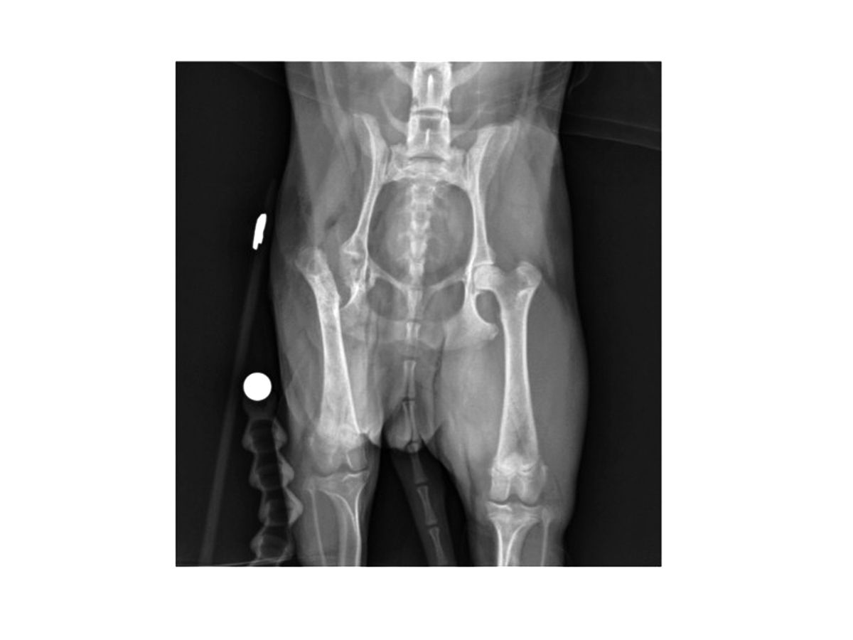 Radiographie postopératoire après une exérèse tête et col du fémur. La ligne d’ostéotomie part de la face médiale du grand trochanter et rejoint le petit trochanter pour limiter le contact interosseux.