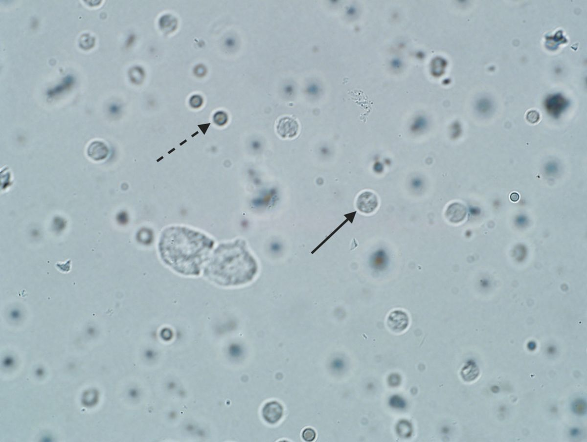 Cytologie urinaire leucocytes