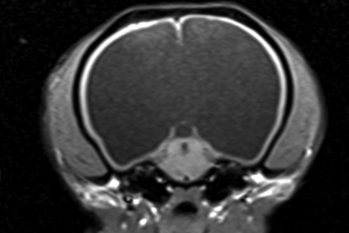 Abbildung 1. Dieses transversale, T1-gewichtete MRT auf Höhe des Mittelhirns zeigt eine hochgradige Vergrößerung der Seitenventrikel mit Verlust des Septum pellucidum, sodass ein einziger, großer mit Liquor gefüllter Raum zurückbleibt.© William B. Thomas