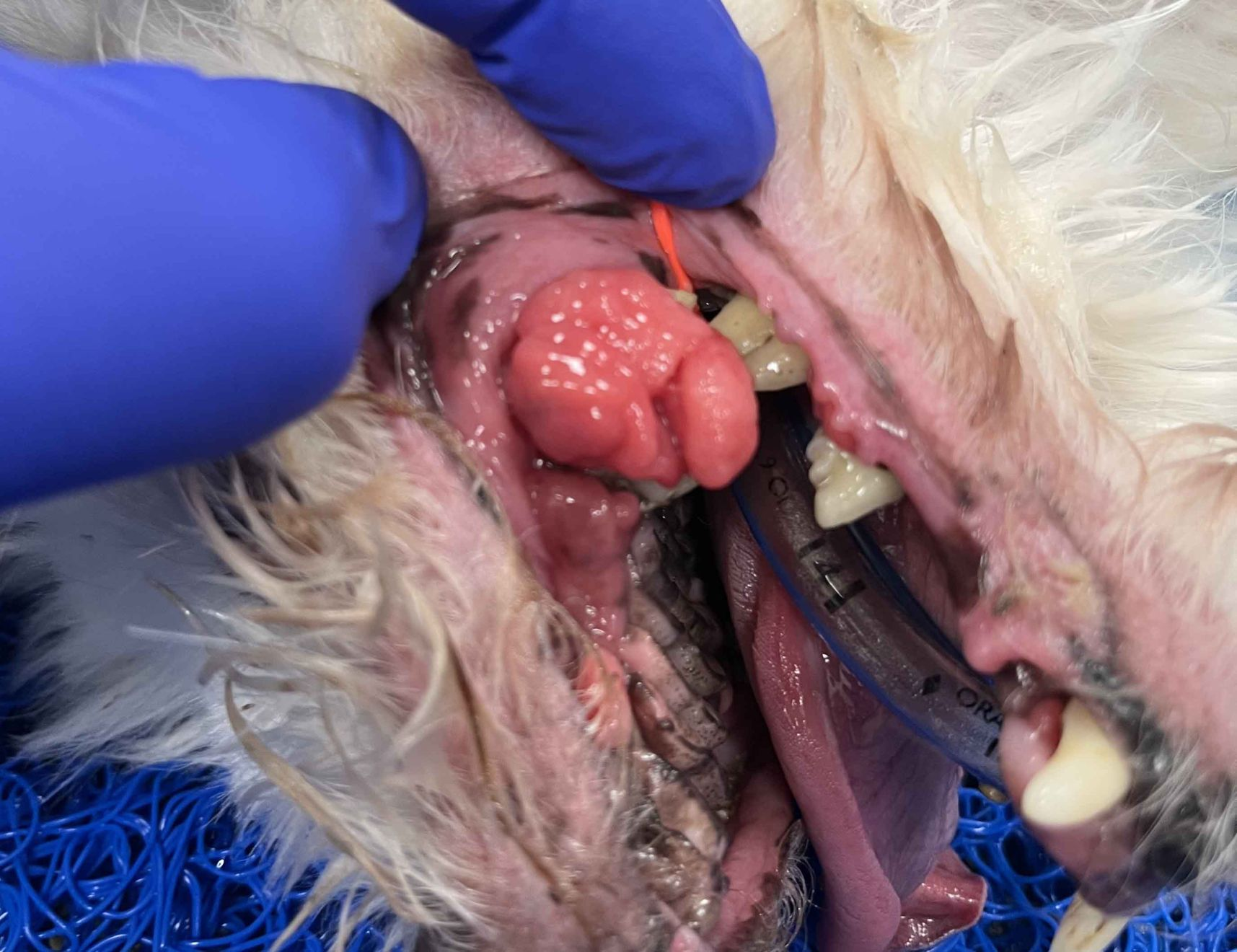 hyperplasie gingivale a