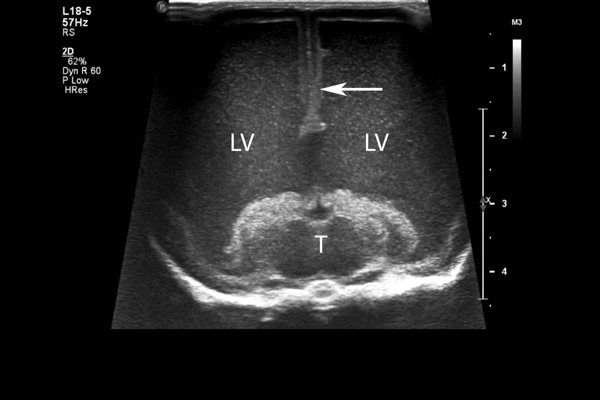Figure 4. Echographie en coupe transversale chez un chien hydrocéphale. Les ventricules latéraux (LV) sont nettement dilatés. Le septum pellucidum, visible en temps normal, a disparu mais la fissure longitudinale reste visible (flèche). Le thalamus est également visualisable (T).