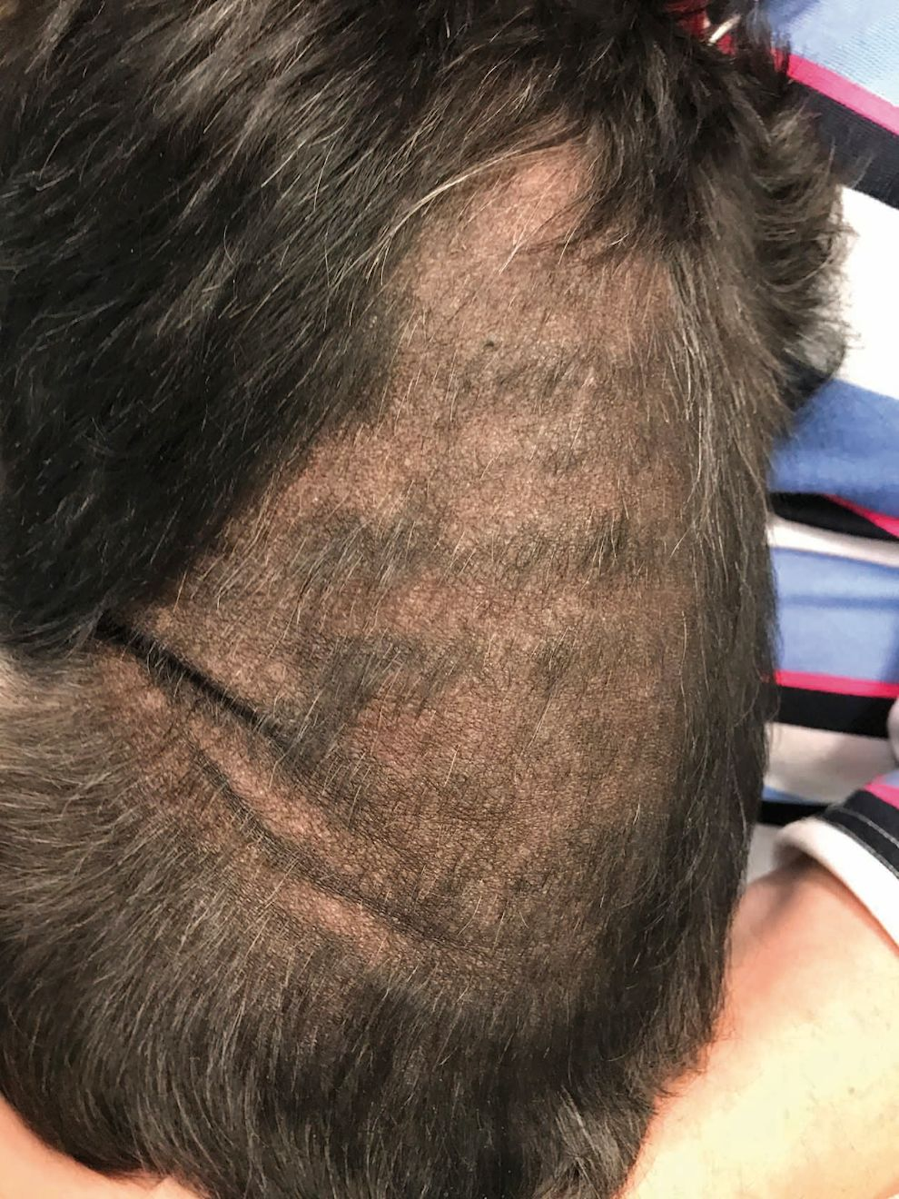 Owners may believe that some of the signs that can develop with hyperadrenocorticism, such as bilateral trunk hypotrichosis.
