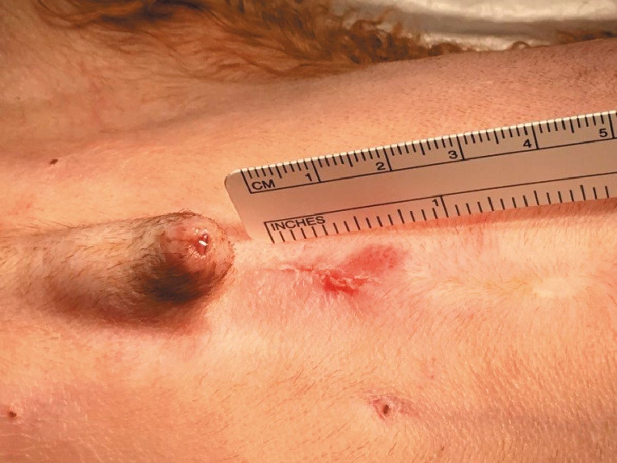Nach dem Eingriff bleibt lediglich eine kleine Hautinzision zurück.