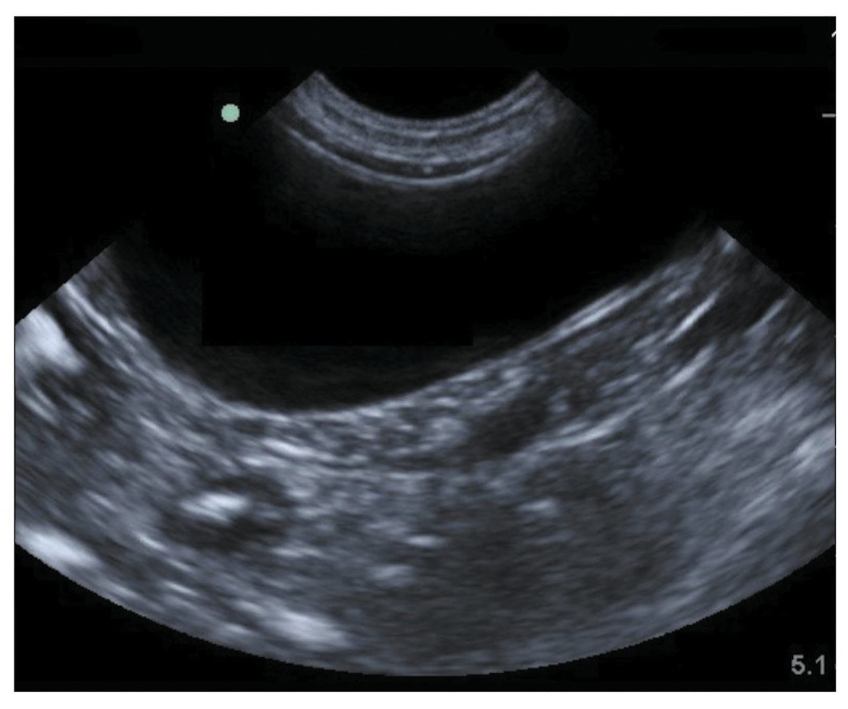 Examen Echographique Exploratoire De L Appareil Urinaire