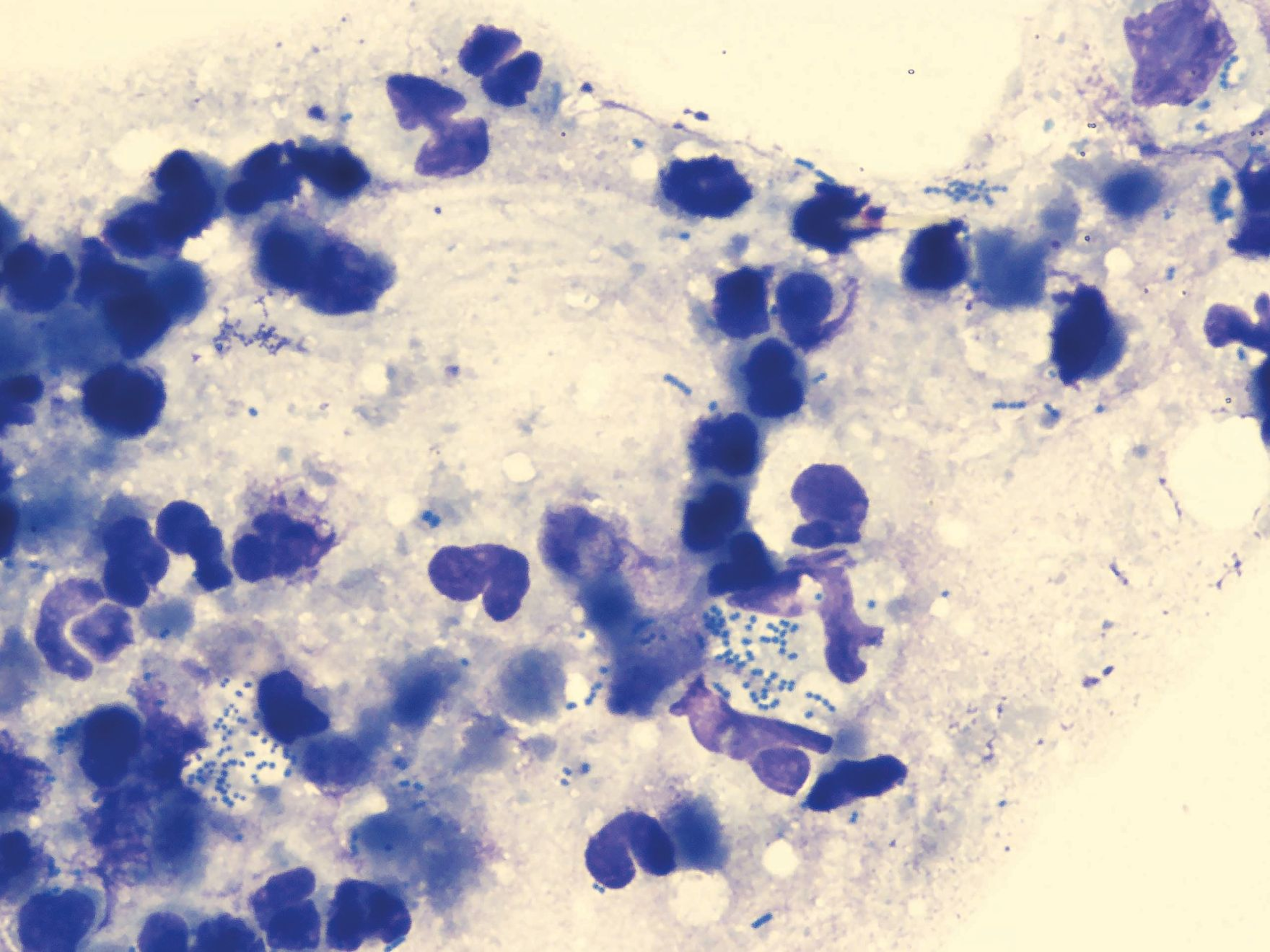 x100 oil immersion of a direct impression smear showing multiple neutrophils with intracellular.