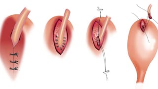 Urolitiasis del tracto urinario superior