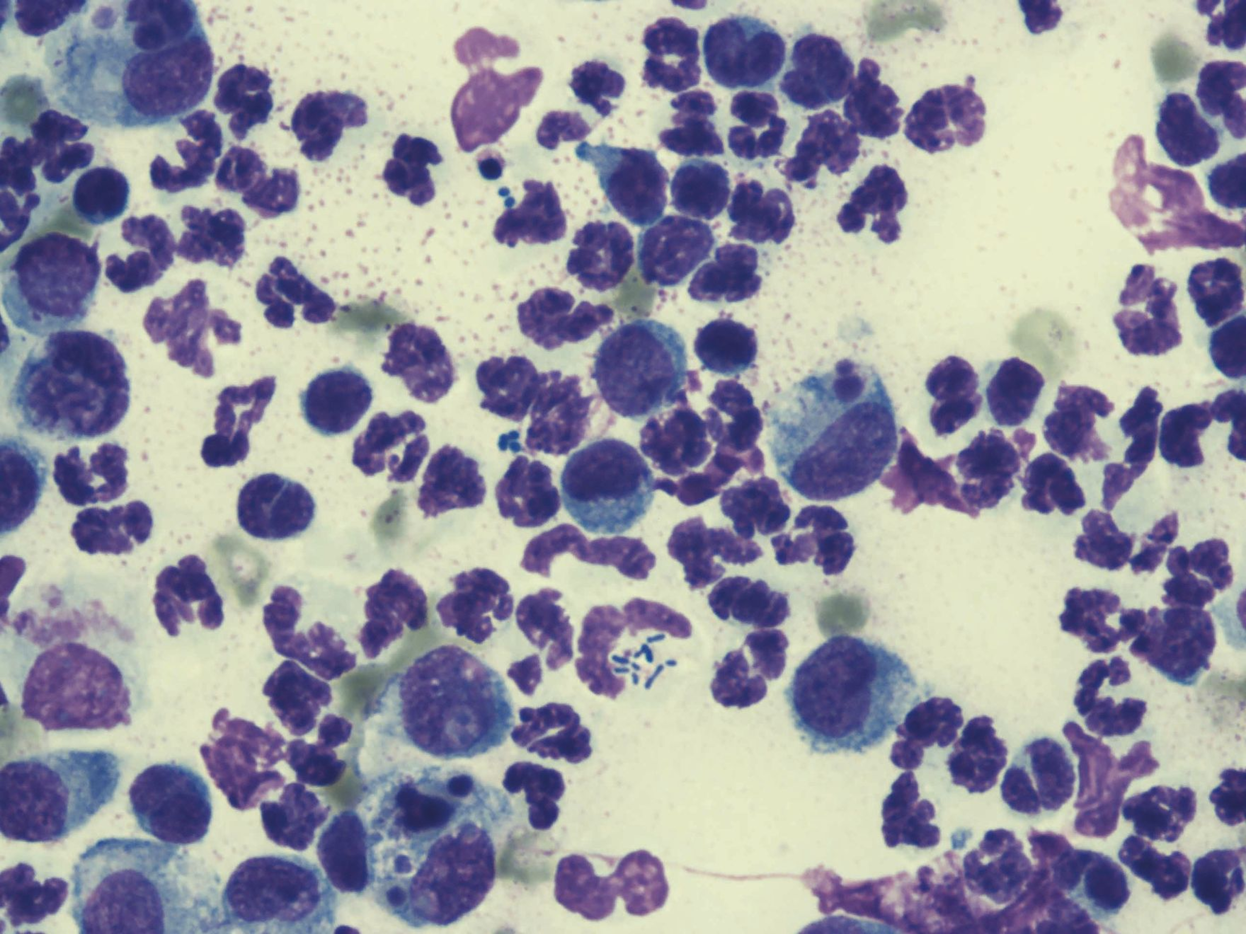 x100 oil immersion of a direct impression smear showing pyogranulomatous inflammation with intracellular.