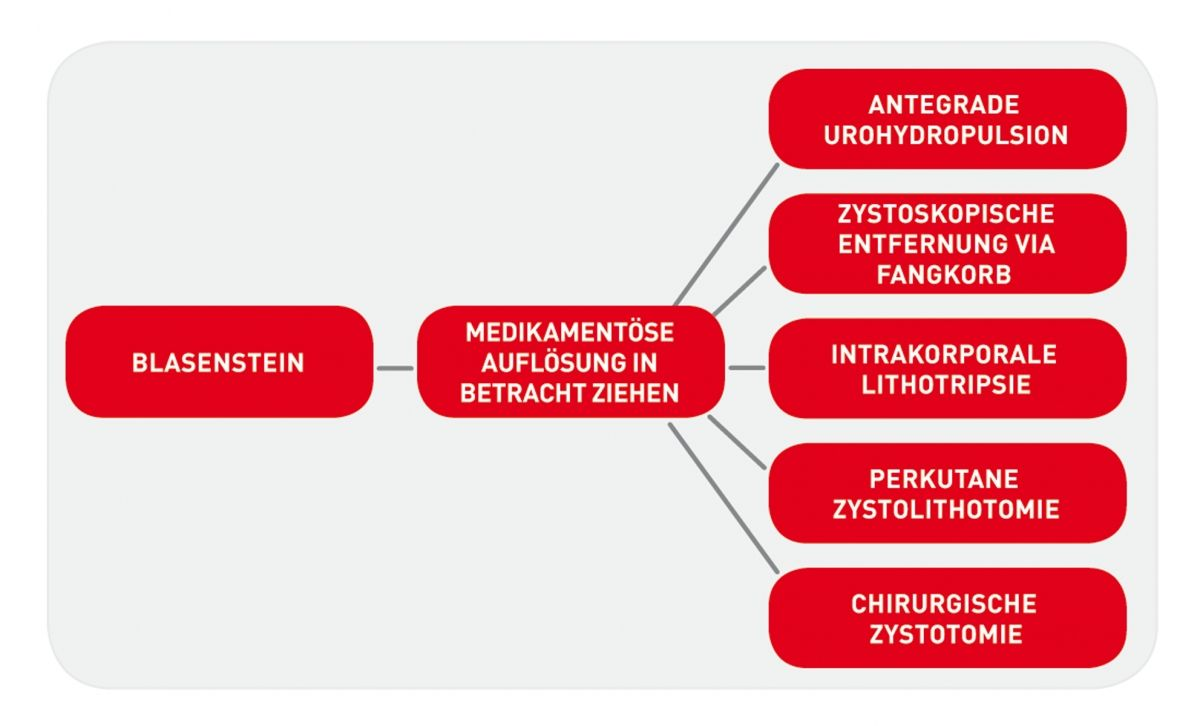 Einfacher Algorithmus für die Wahl der Methode zur Entfernung von Harnblasensteinen.