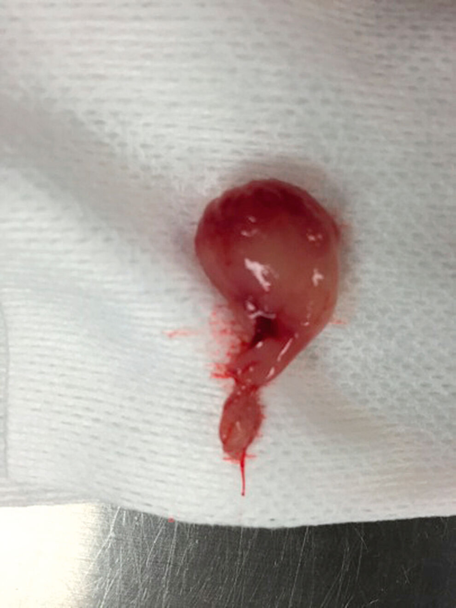 Figure 3. This nasopharyngeal polyp was removed from a young kitten with clinical signs that included sneezing, gagging, and stertor.