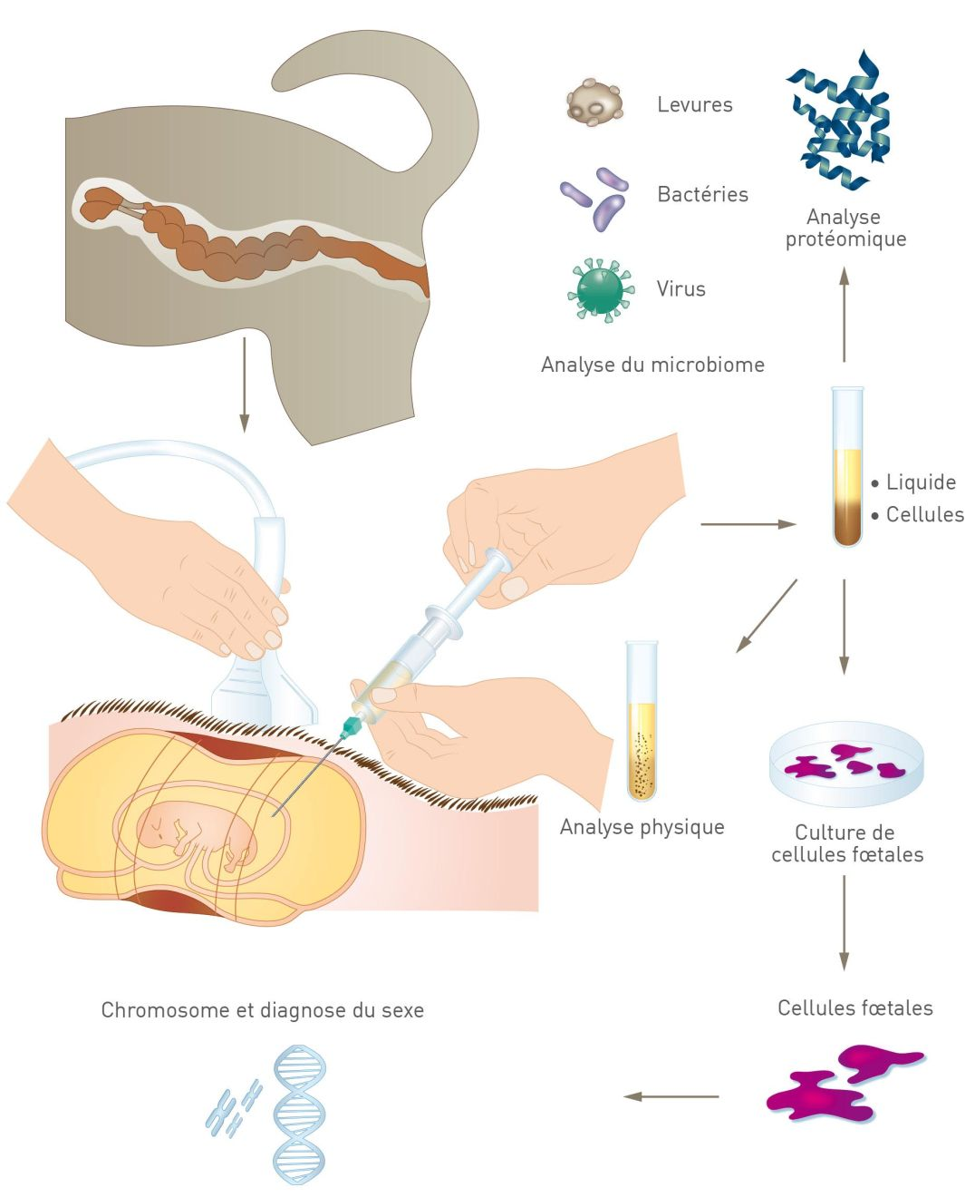 La centèse du liquide fœtal peut aider au diagnostic et à la recherche