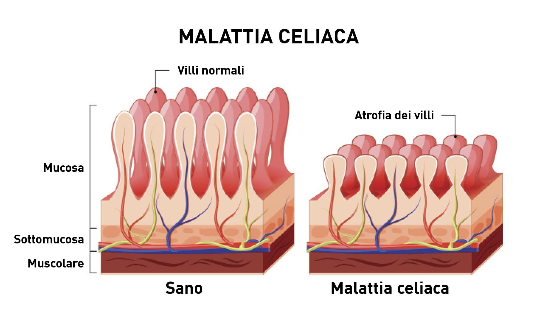 malattia celiaca 