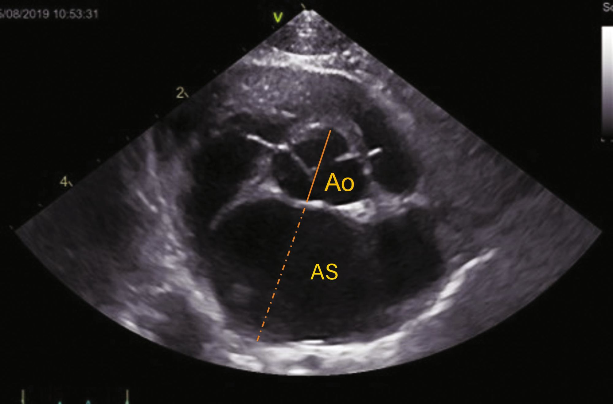 Evaluare ecocardiografică a cardiomiopatiei hipertrofice (HCM). 