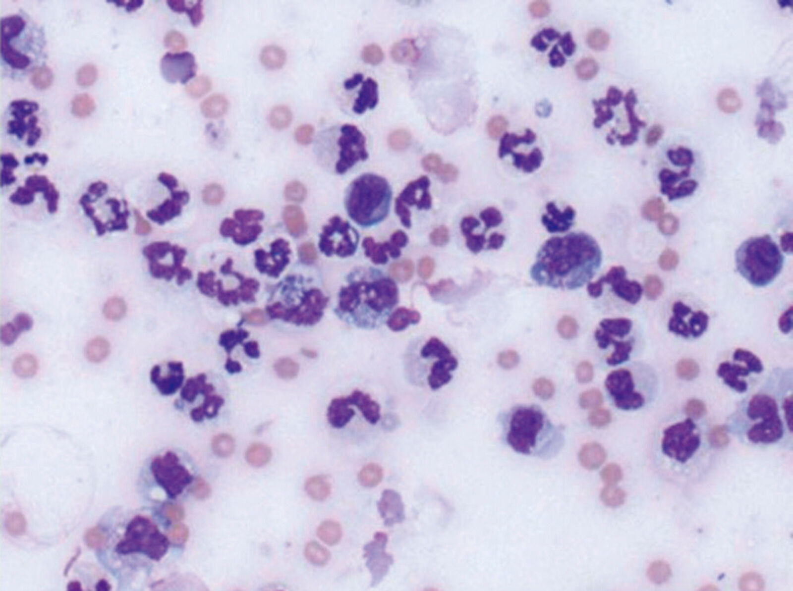 Abdominal effusion at 100X magnification. Note the high number of neutrophils. Intracellular bacteria are also present and can be better visualized at higher magnification.