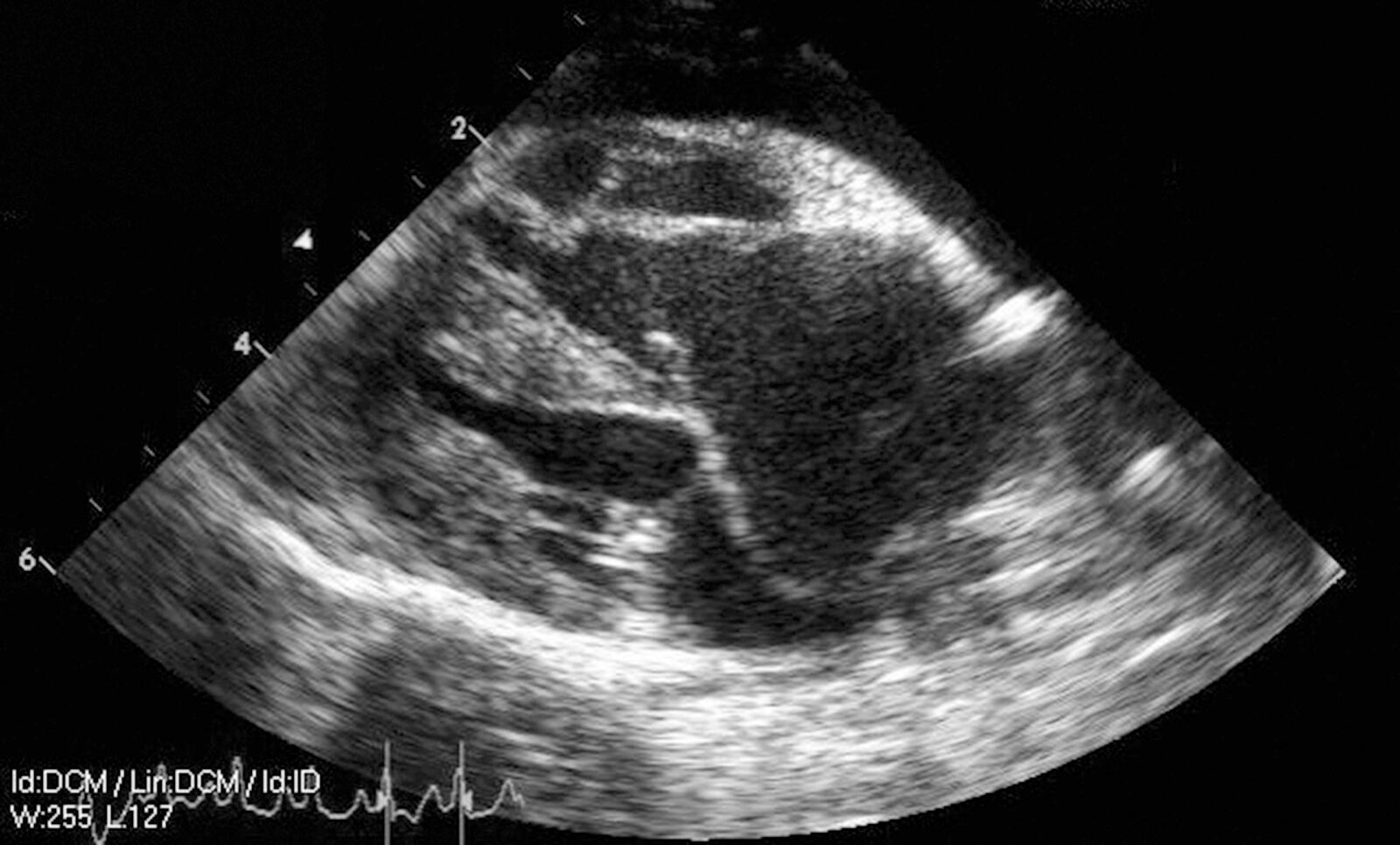 Proiezione ecocardiografica sull’asse lungo parasternale destro che mostra la grave dilatazione dell’atrio destro e del ventricolo destro secondaria a displasia della valvola tricuspide.