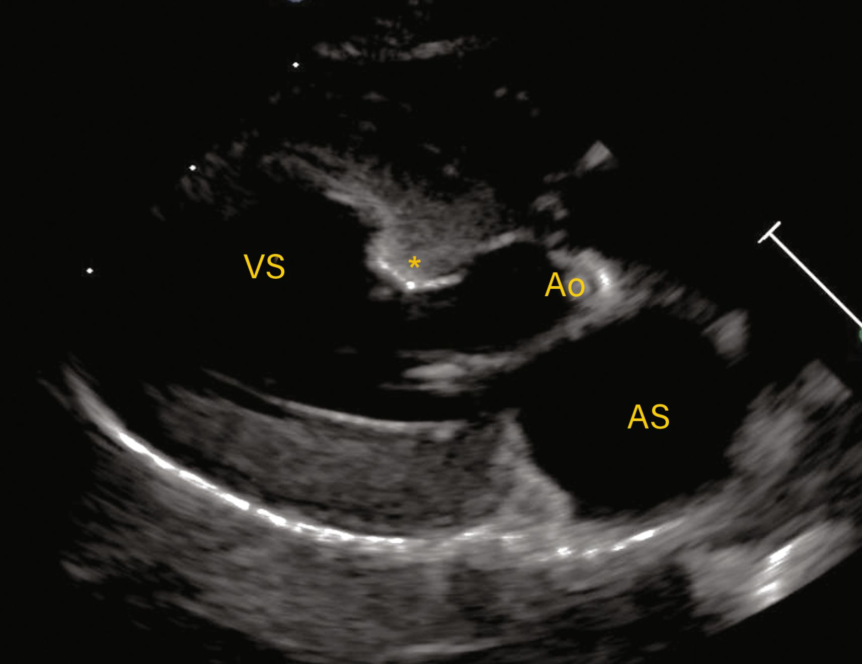 Vizualizare parasternală dreaptă în ax lung cu 5 camere care arată hipertrofia localizată la nivelul septului bazal (*) ca fiind cauza LVOTO. 