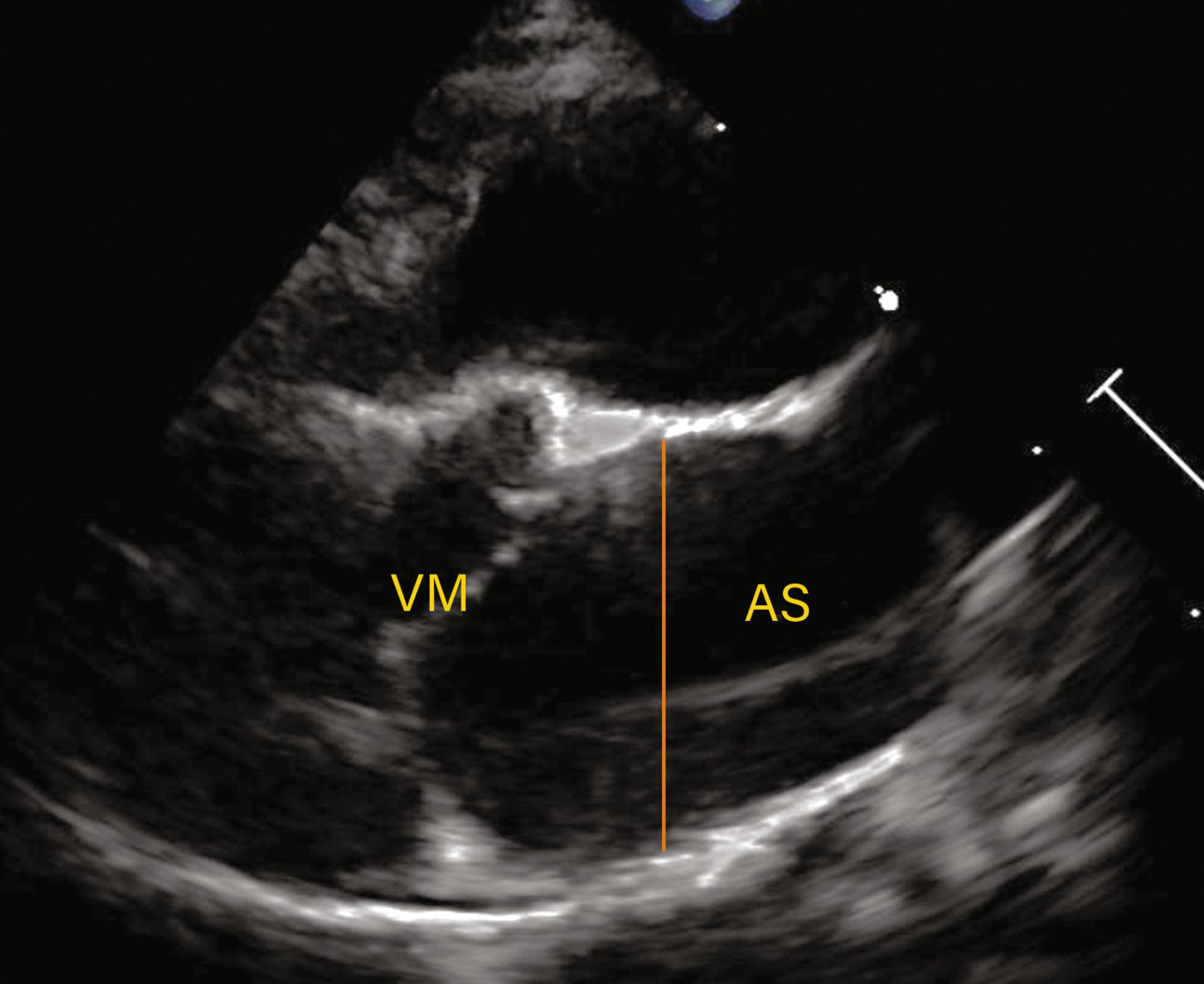 Evaluare ecocardiografică a cardiomiopatiei hipertrofice (HCM). 
