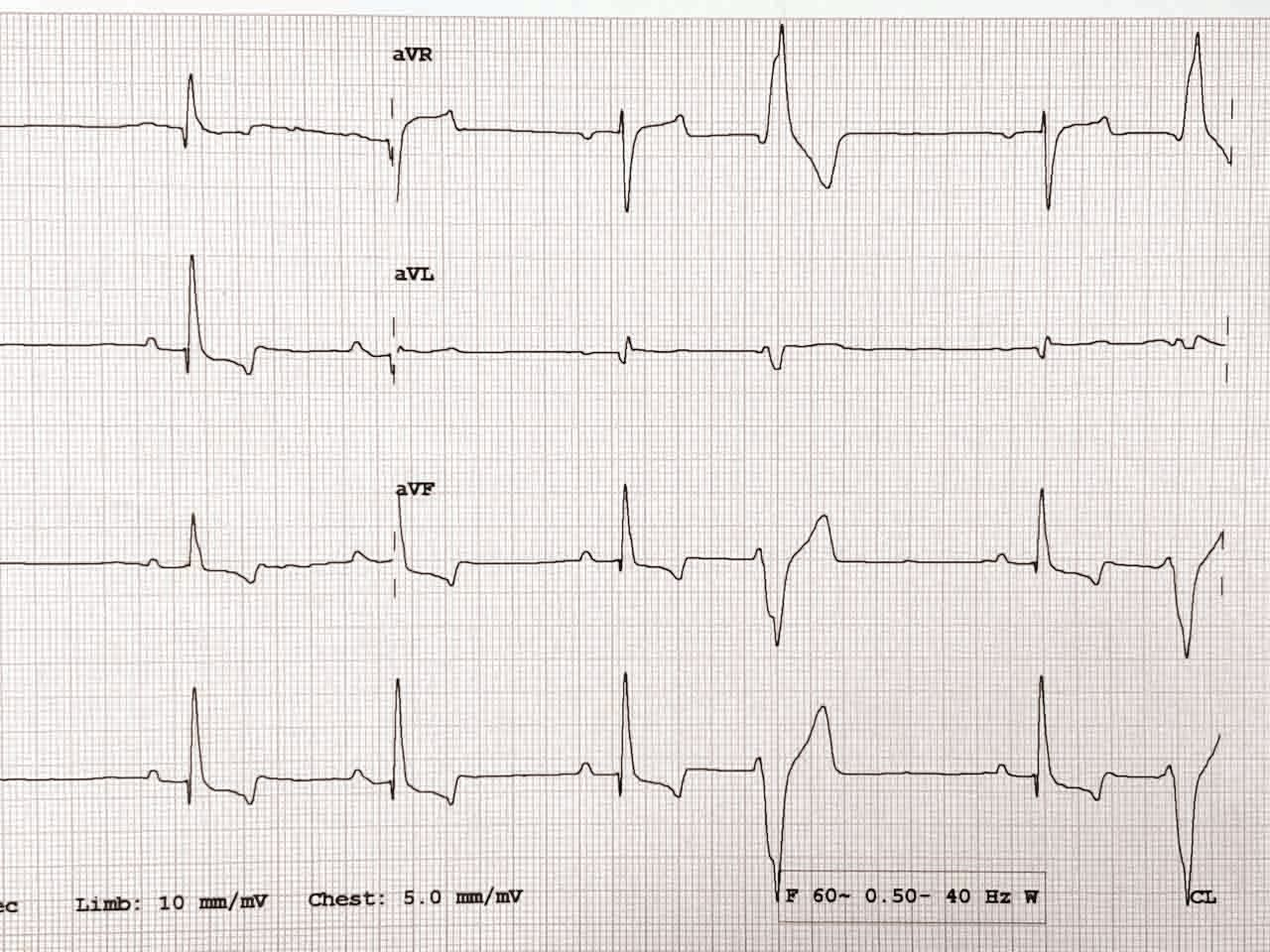 ECG d’un Golden Retriever de 2 ans avec une CMD confirmée associée à l’alimentation