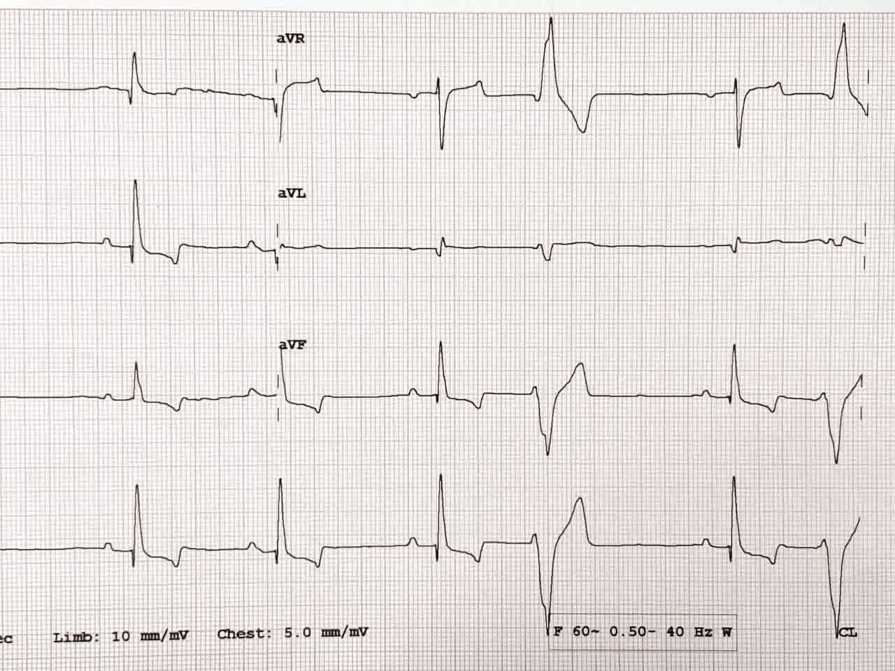An ECG is shown from a 2-year-old Golden Retriever with confirmed diet-associated DCM