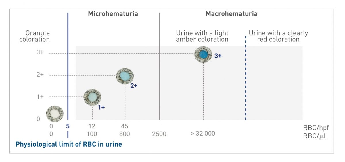 The coloration of the granules will vary according to the concentration of blood in the urine; the image shows the response for a urine sample at pH = 6, USG = 1.026 ( 4 ).