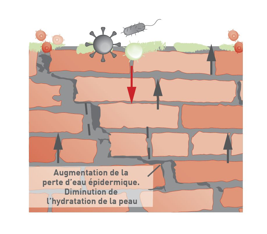 une barrière épidermique altérée facilite la pénétration des microbes et des allergènes dans la peau