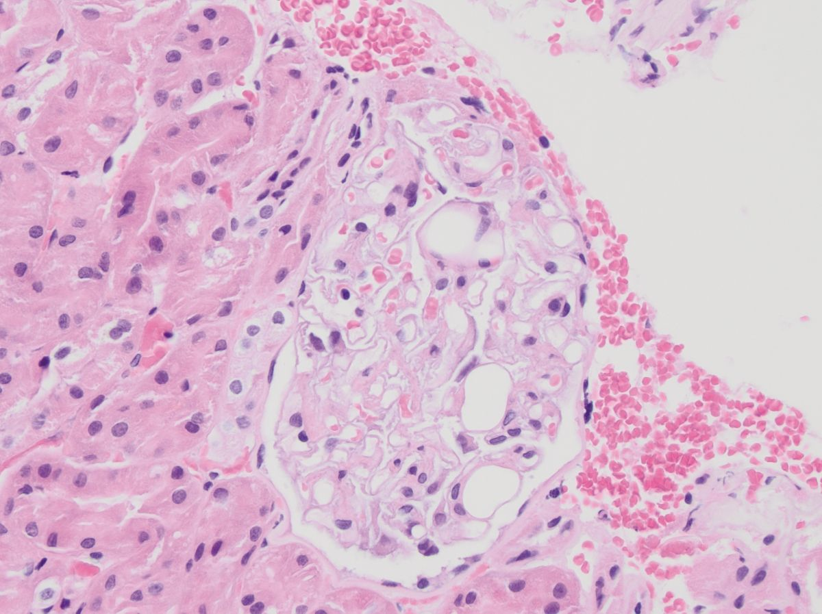 Thrombo-embolie lipidique glomérulaire chez un schnauzer nain mâle castré de 10 ans, avec hypertriglycéridémie primaire et protéinurie subclinique. Les thrombo-emboles lipidiques apparaissent comme des structures circulaires intracapillaires non colorées : hématoxyline et éosine. L’image a été prise au grossissement x 40.