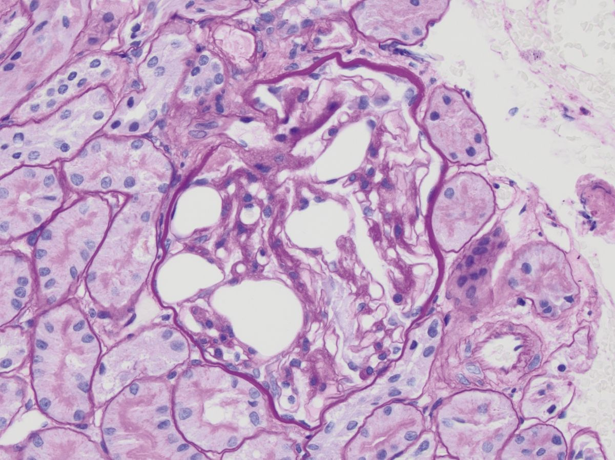 Thrombo-embolie lipidique glomérulaire chez un schnauzer nain mâle castré de 10 ans, avec hypertriglycéridémie primaire et protéinurie subclinique. Les thrombo-emboles lipidiques apparaissent comme des structures circulaires intracapillaires non colorées : acide périodique de Schiff. L’image a été prise au grossissement x 40.