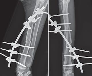 Radiografie postoperatorie medio-laterale e cranio-caudale di una frattura aperta del radio con fissatore scheletrico esterno applicato. Tali dispositivi sono scelte eccellenti per la fissazione della frattura esposta perché permettono la cura della ferita aperta, preservando al tempo stesso l’apporto ematico dell’osso e minimizzando la compromissione dei tessuti molli.