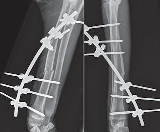 Postoperative mediolaterale und craniocaudale Röntgenaufnahmen einer offenen Radiusfraktur mit externem Fixateur. Externe Fixatoren sind ideal geeignet für die Stabilisierung offener Frakturen, da sie eine regelmäßige Versorgung offener Wunden zulassen und dabei gleichzeitig die Blutversorgung des Knochens erhalten und Weichteilgewebeverletzungen minimieren.