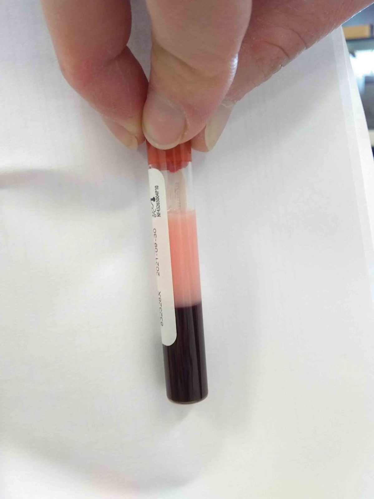 O soro lipêmico de uma amostra de sangue pode ser indicativo de hipertrigliceridemia. A lipemia macroscópica indica um aumento dos triglicerídeos de pelo menos 200 mg/dL.