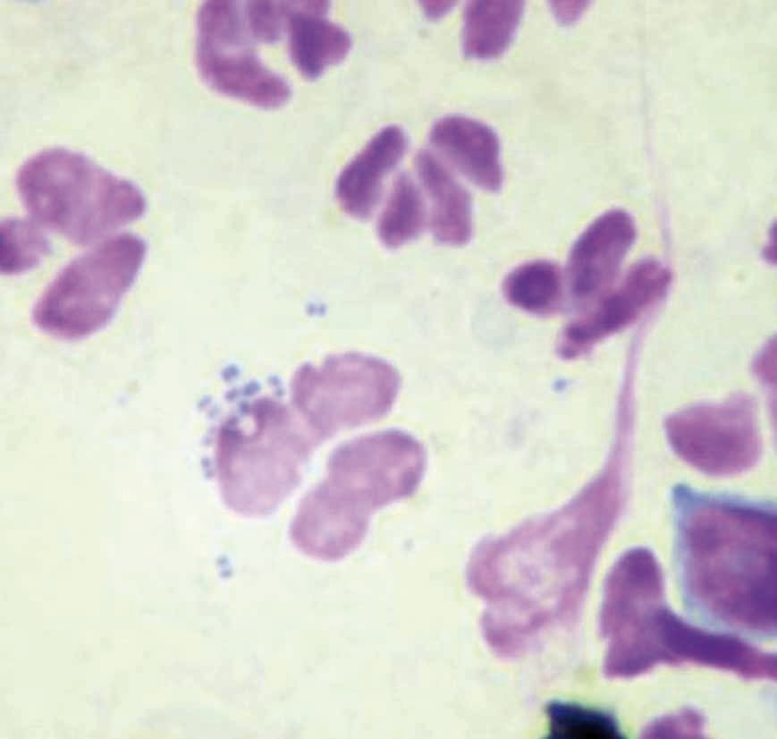 A microscopic image showing non-degenerate and degenerate neutrophils.